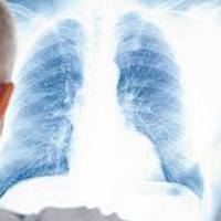 В Україні масово закривають протитуберкульозні медустанови