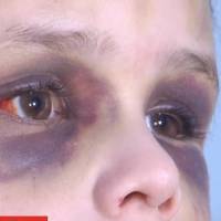 “Дитинка не встає, все обличчя в синяках”: п’яна горе-мати жорстоко побила 6-річну доньку