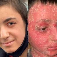 Я знайшла Мар’яна в палаті, закутаного в лікарняний коц.. Його привезли з інтернату. Він він весь тремтів і роздирав своє тіло через дикий свербіж.