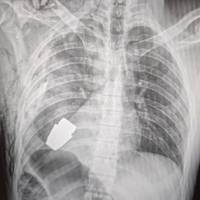 Операція під наглядом саперів: з тіла бійця ЗСУ дістали гранату, яка не розірвалася