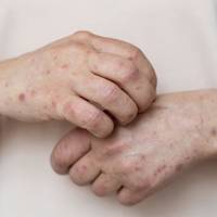 Кількість випадків смертельної хвороби різко збільшилась в Україні